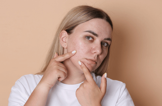 טיפול באקנה ללא רואקוטן