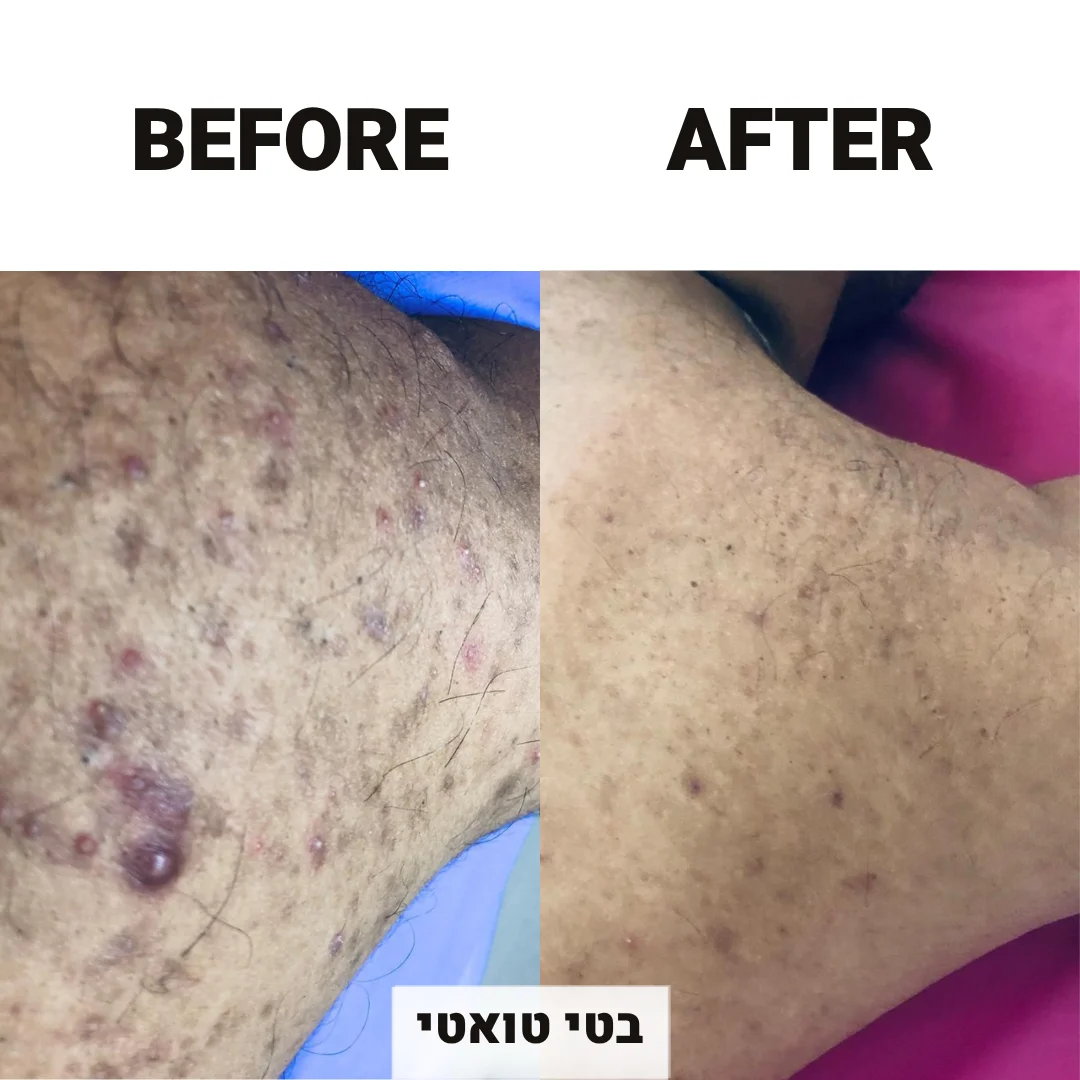 לפני אחרי טיפול אקנה