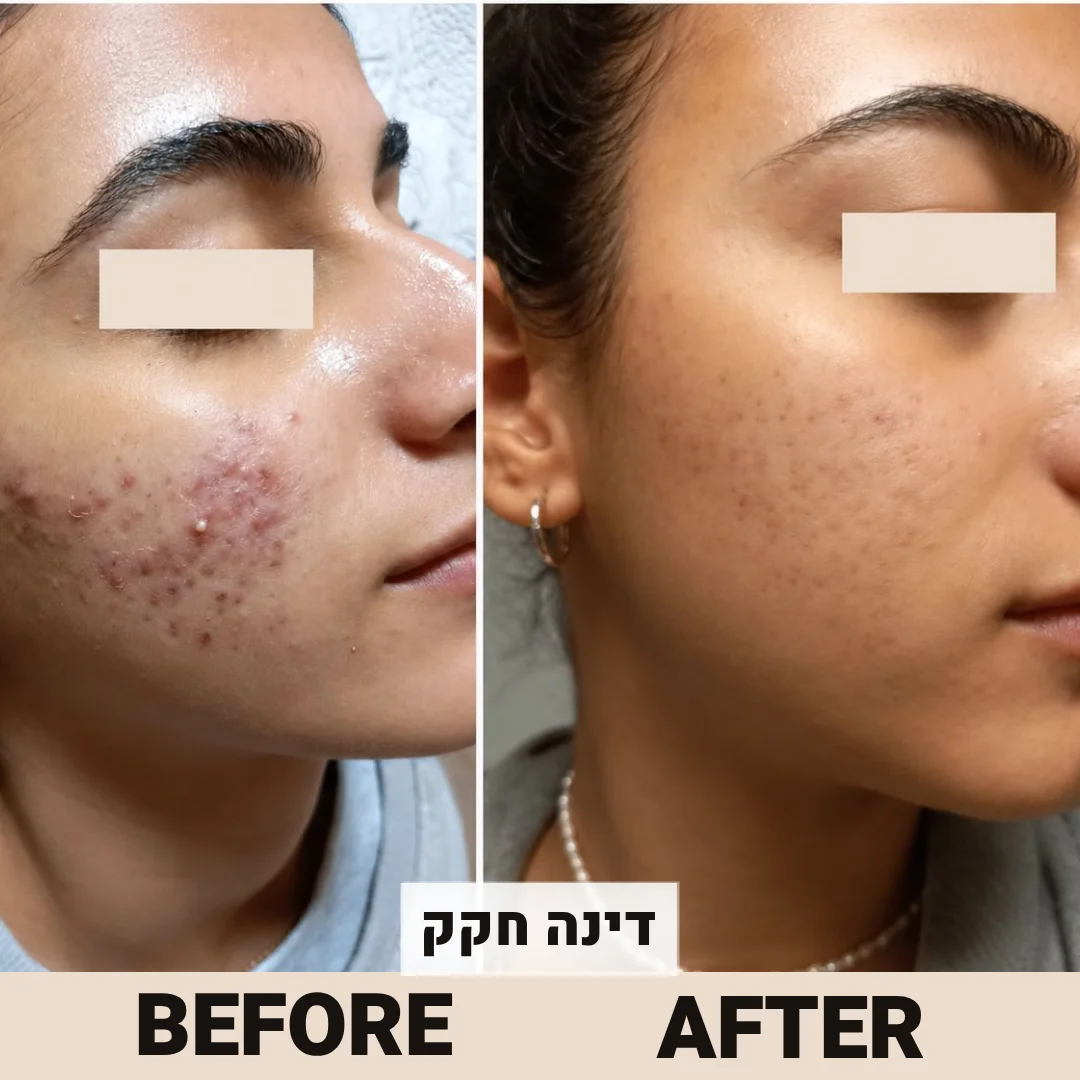 לפני אחרי טיפול אקנה