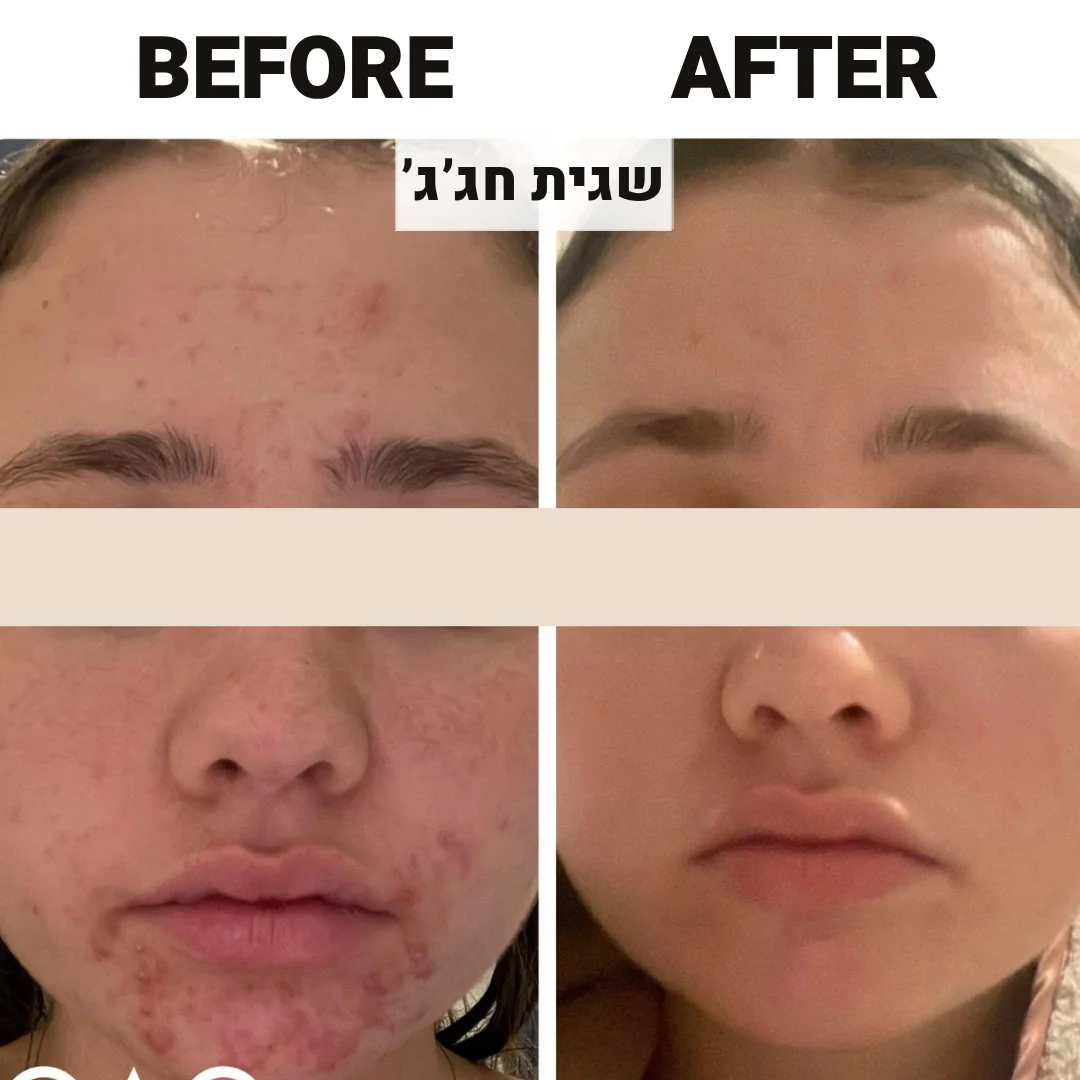 לפני אחרי טיפול אקנה