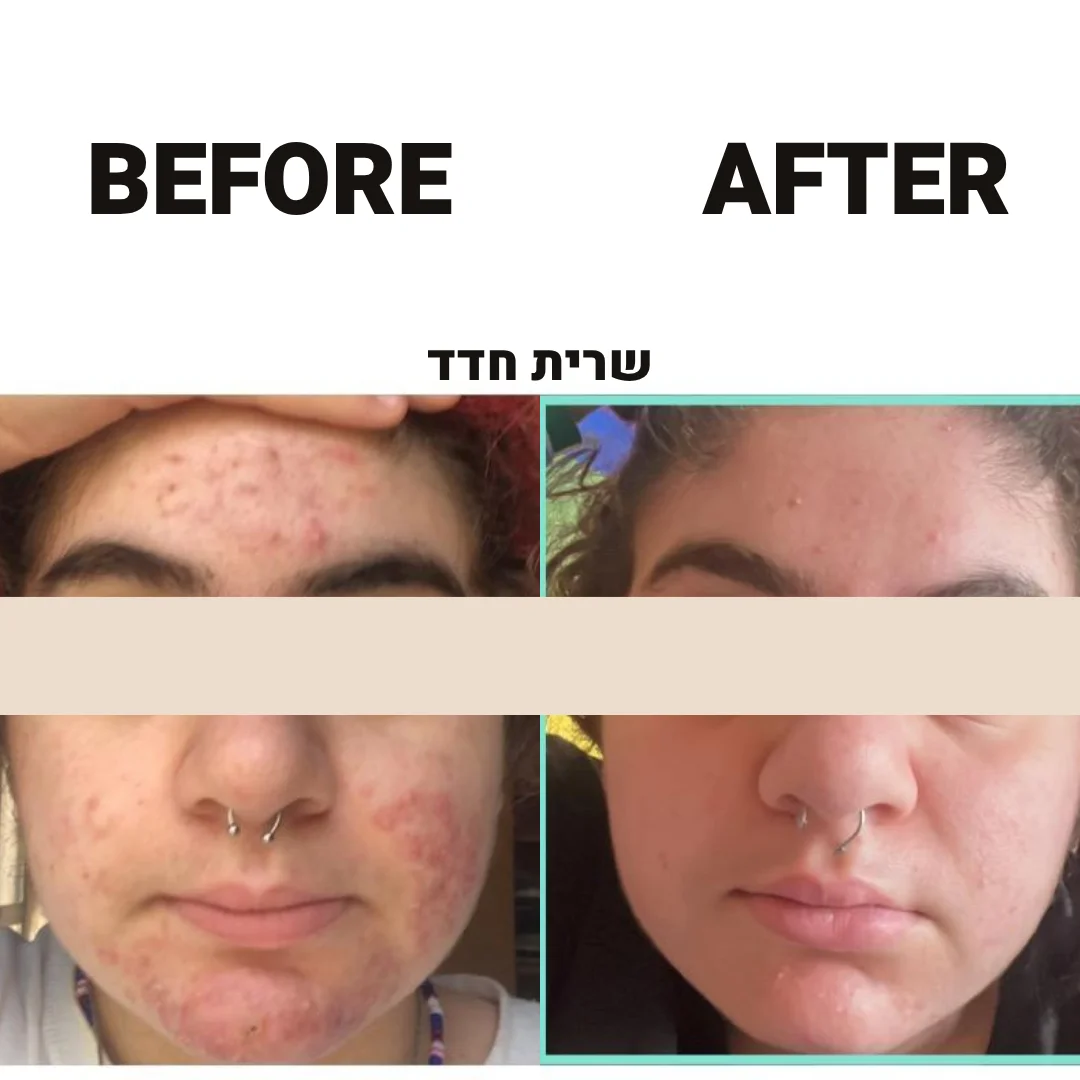 לפני אחרי טיפול אקנה