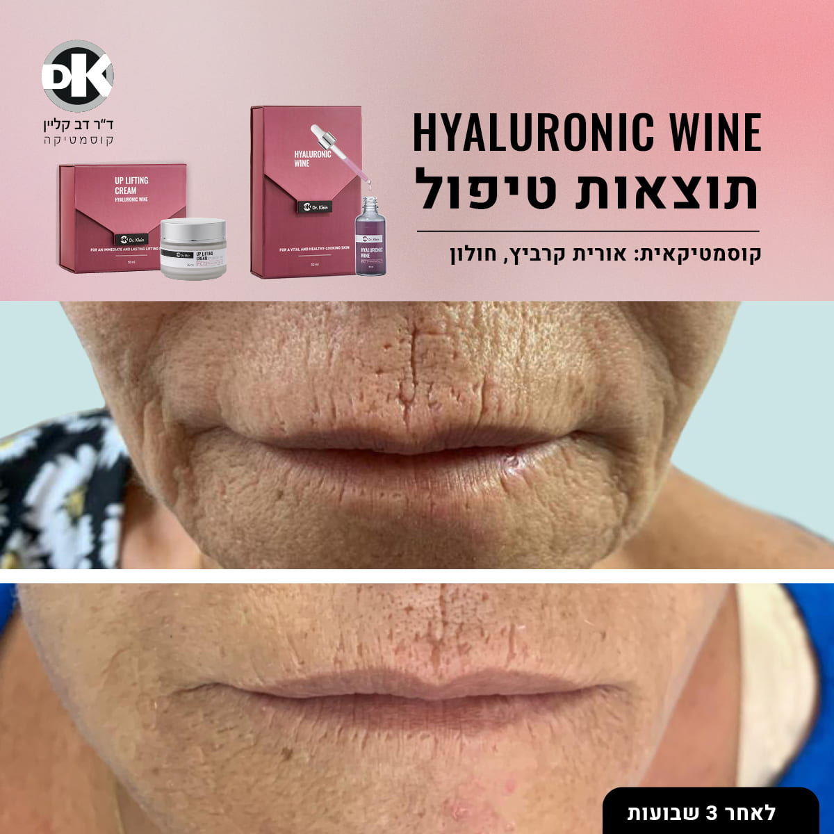 תוצאות טיפול סדרת תכשירים היאלרוניק ווין - לפני אחרי