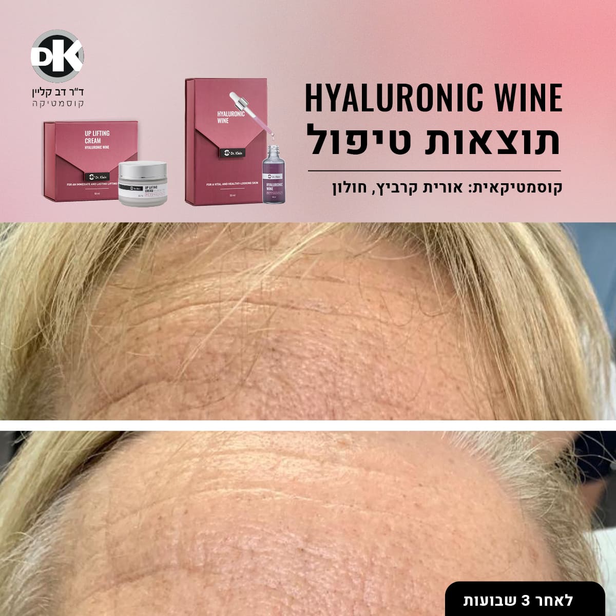 תוצאות טיפול היאלרוניק ווין - לפני אחרי